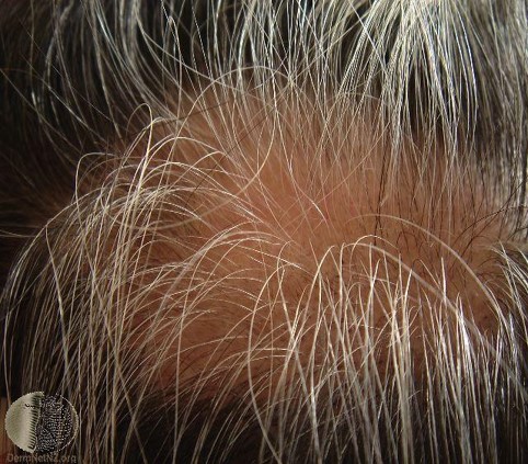 Alopecia areata