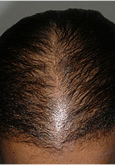 Hair loss products