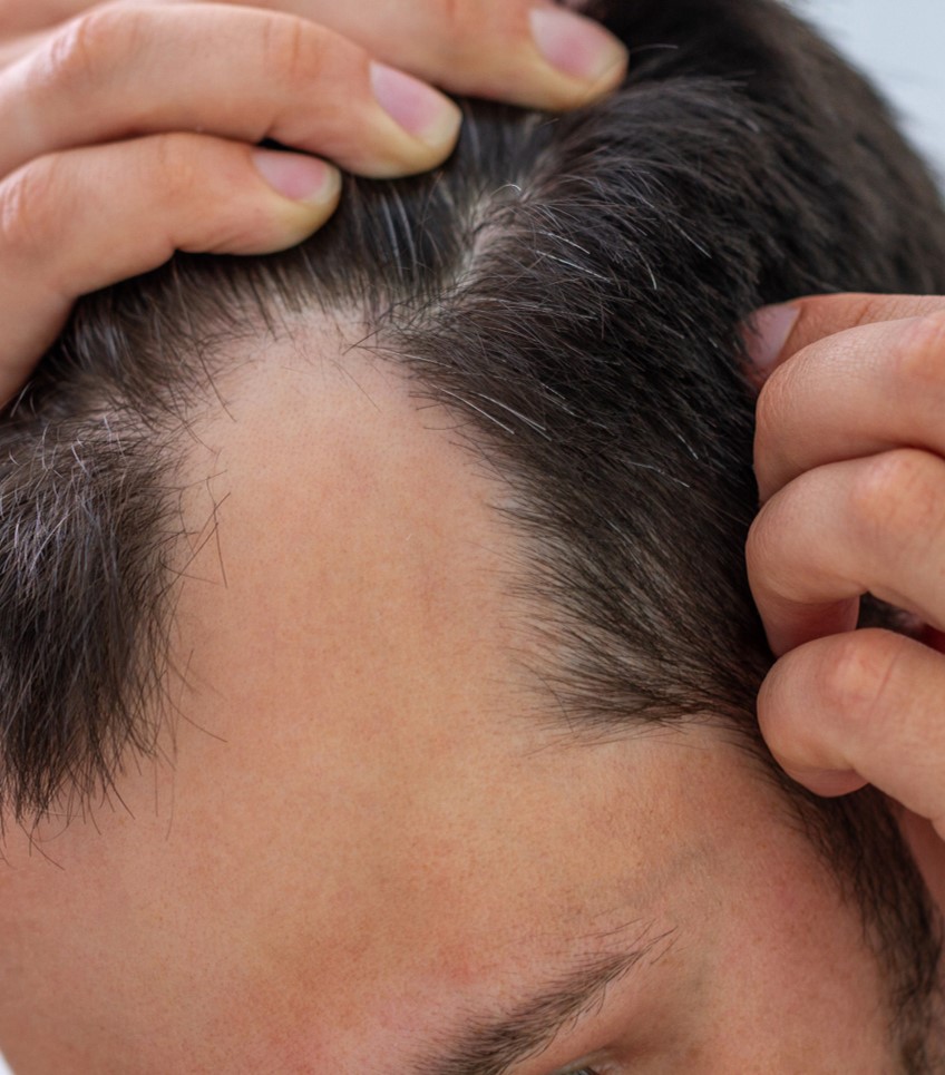 Male hair loss