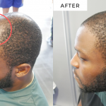 MS Hair fibres