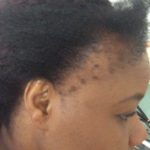 Traction alopecia