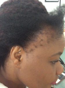 Traction alopecia
