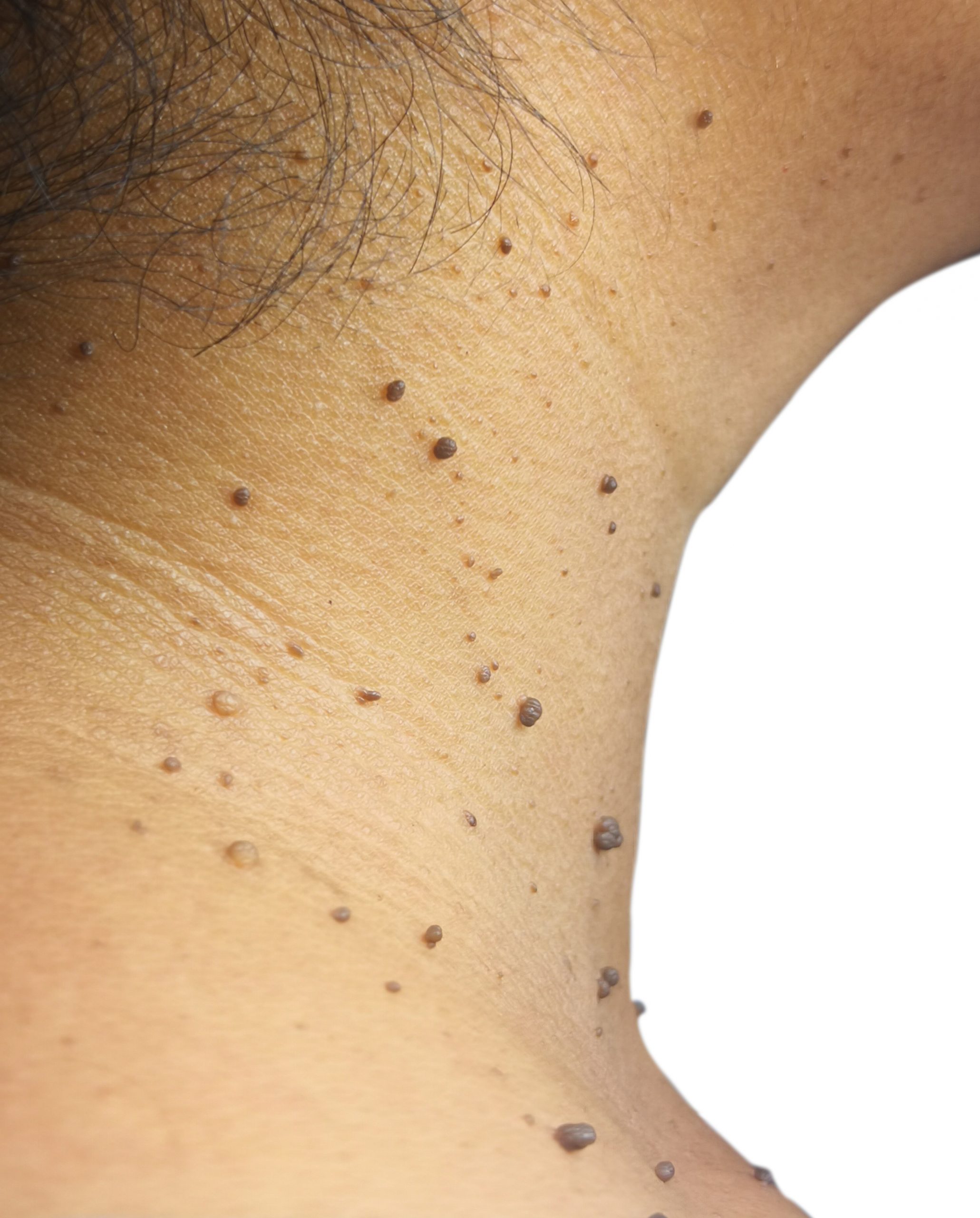 Skin tag removal with electrolysis