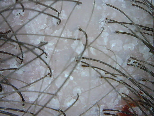 Microscopic view of itchy scalp with scale before treatment