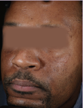 After Hyperpigmentation 3 Rejuvenating Peels including 2 peels that were layered with Brightening Peel