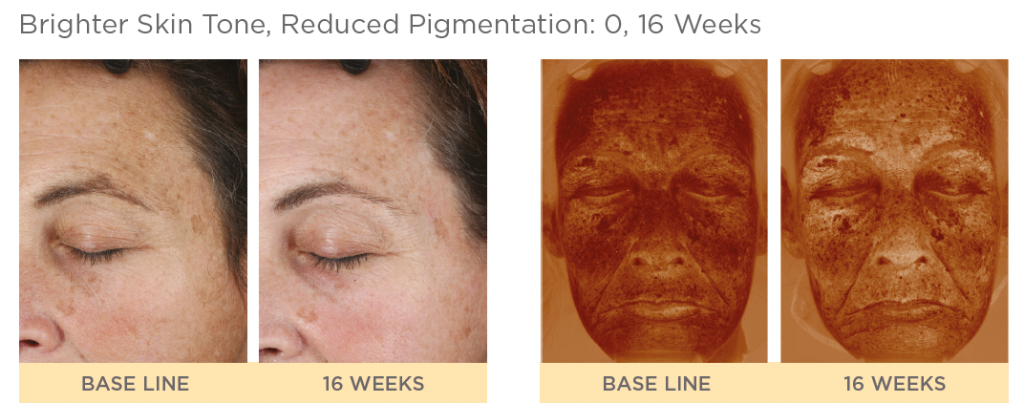 NeoStrata Enlighten Before and After