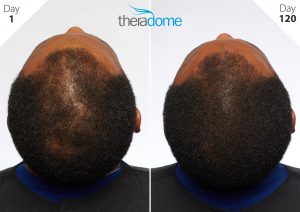 Before and after Photographs following Theradrome use