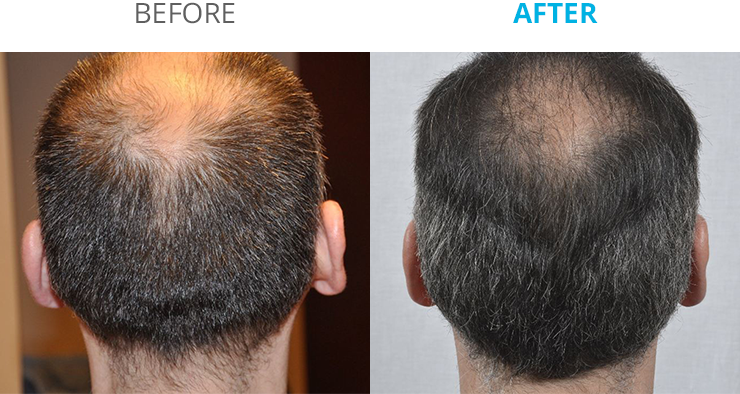 Before and after Photographs following Theradrome use