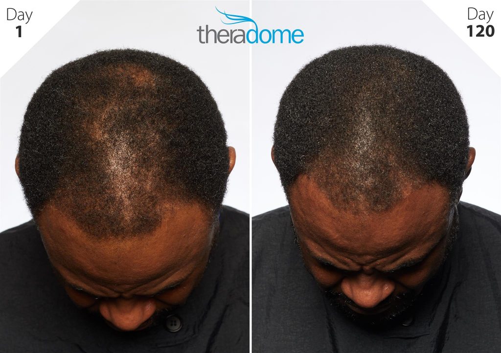 Before and after Photographs following Theradrome use