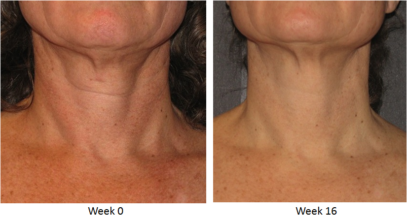 Skin Active Triple Firming Neck Cream Before and After 3