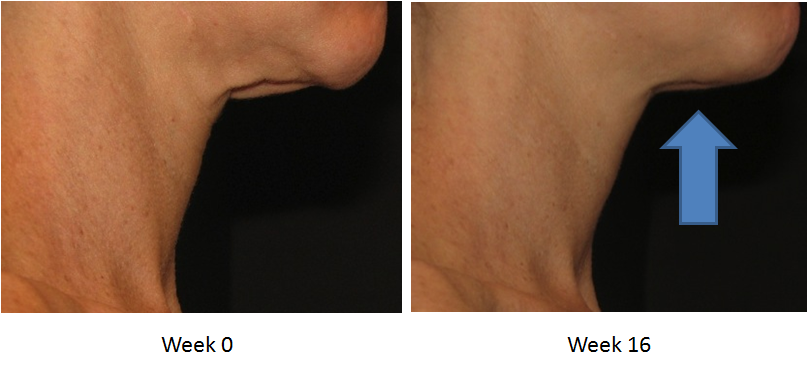 Skin Active Triple Firming Neck Cream Before and After 4