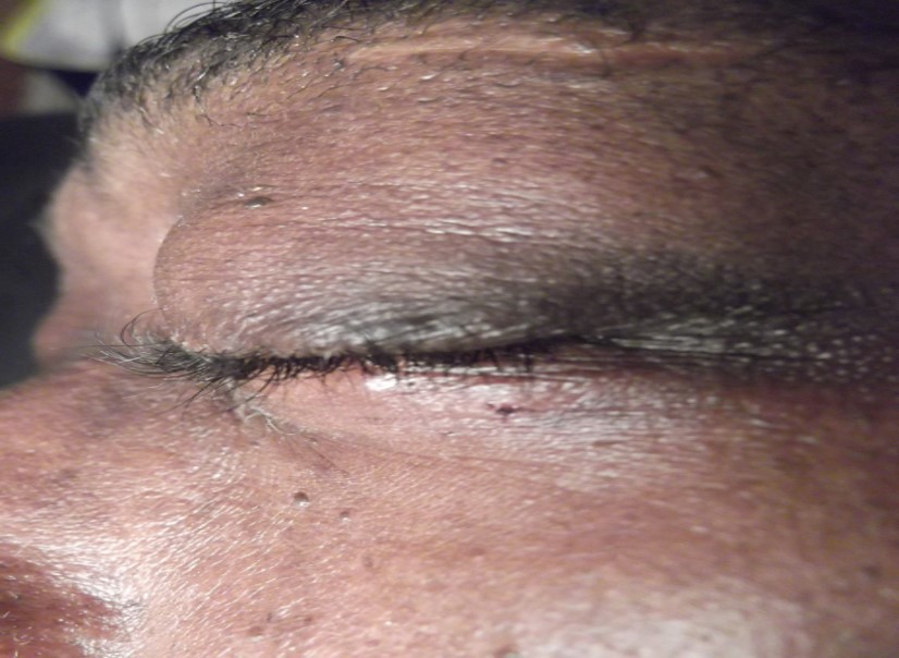 Dermatosis papulosa nigra after electrolysis