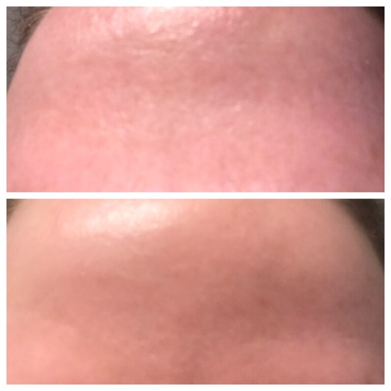 WOW fusion before and after for open pores