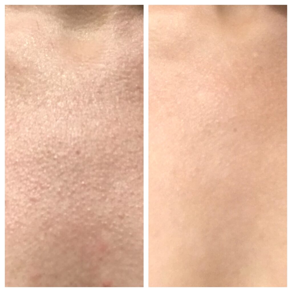 WOW fusion  before and after on the chest