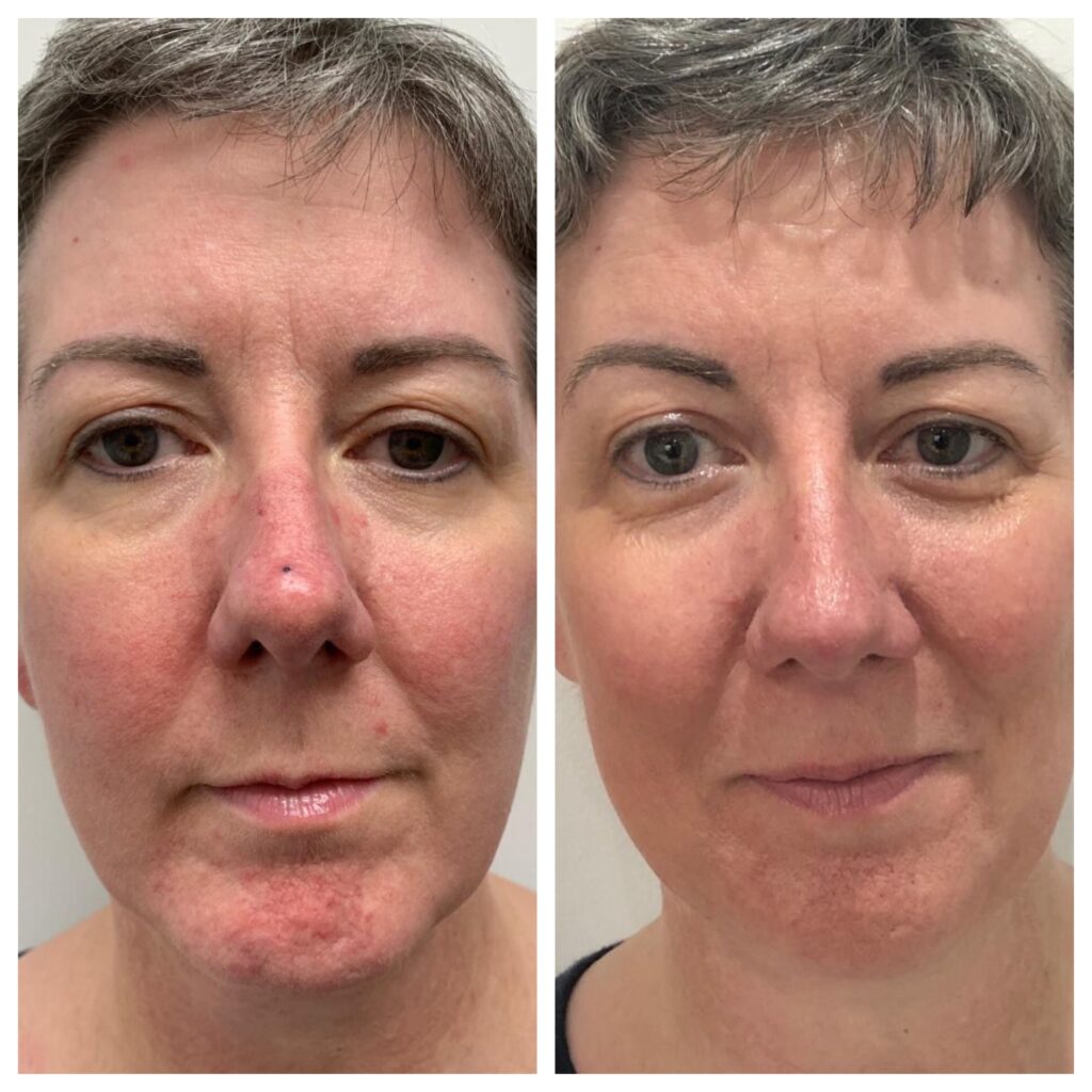 WOW fusion for rosacea, before and at 5 weeks