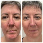 WOW fusion for rosacea, before and at 5 weeks