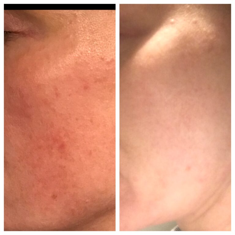 WOW fusion before and after for rosacea