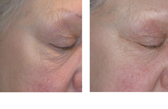 ProSystem Rejuvenating Peel for Rosacea, and under eye wrinkles - baseline to 4 peels