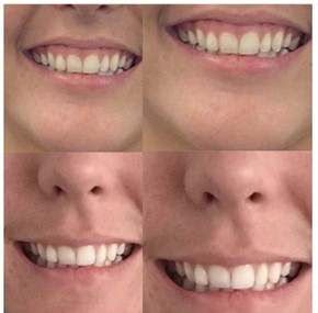 Gummy smile before and after