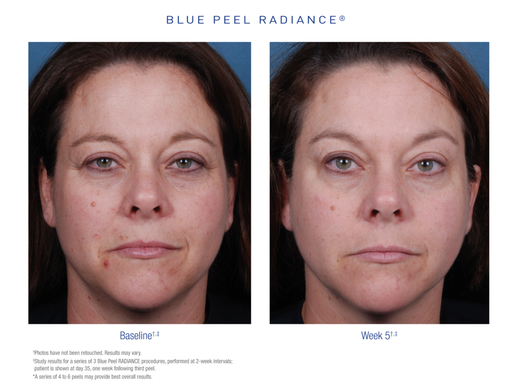 Obagi Blue Peel Radiance