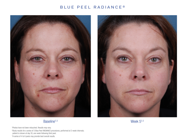 Obagi Blue Peel Radiance