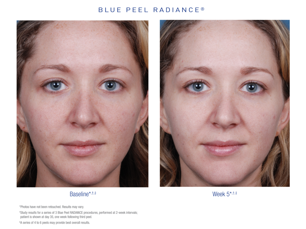 US_BPR_Before_After_2_small