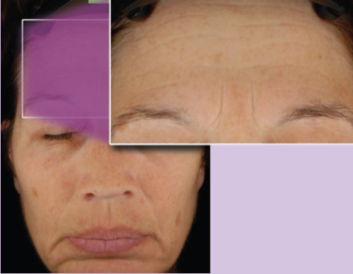 After Alternating peels and microdermabrasion over 16 weeks; 4 Rejuvenating Peels 4 x 20%