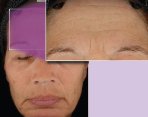 Neostrata Prosystem peel Baseline Alternating peels and microdermabrasion over 16 weeks; 4 Rejuvenating Peels 4 x 20