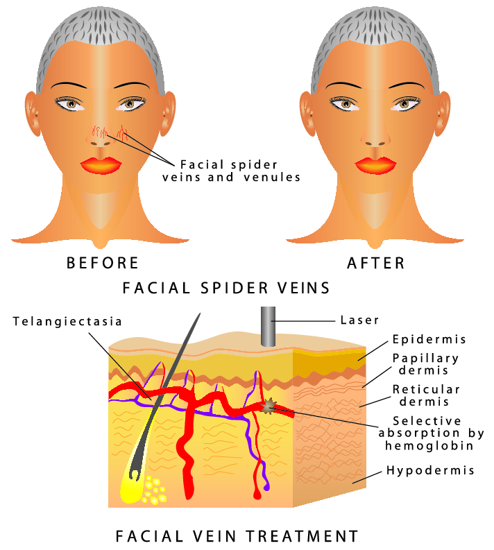 facial red veins laser