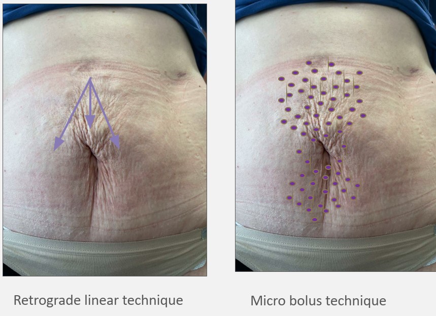 Number of treatments: 3-4 .Interval: 3-4 weeks apart