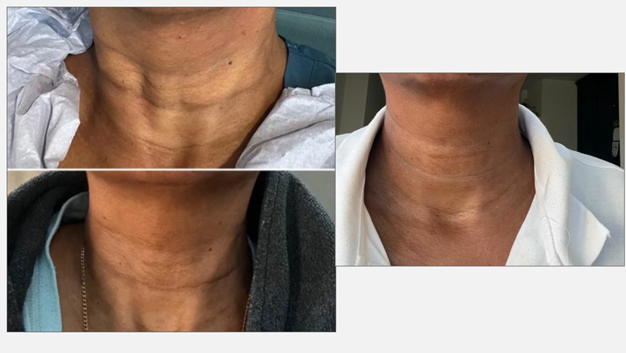 Neck regeneration
Plenhyage XL Strong - 2 sessions
Results after 6 weeks
Pictures courtesy of Nurse Prescriber 
H. Gordon - UK