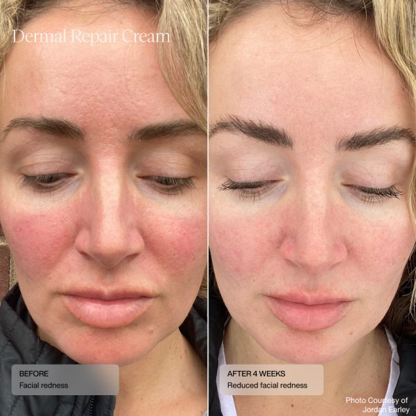 Dermal Repair Cream- before and after