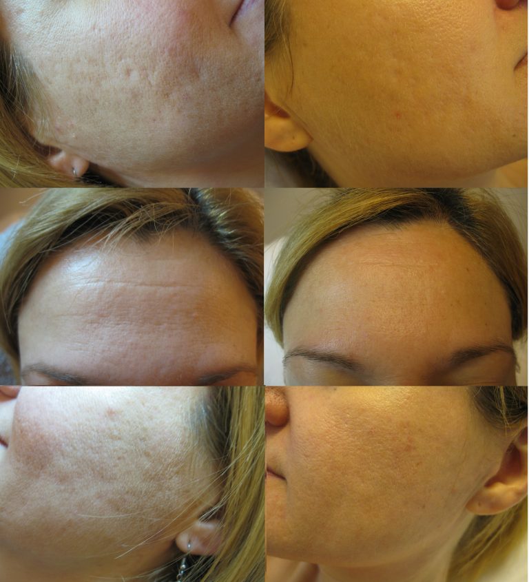 Needling vorher nachher