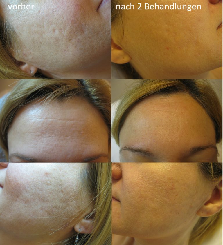 Needling vorher nachher2