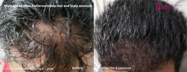 hair and scalp Bally Beauty b&a male 42 8 sessions