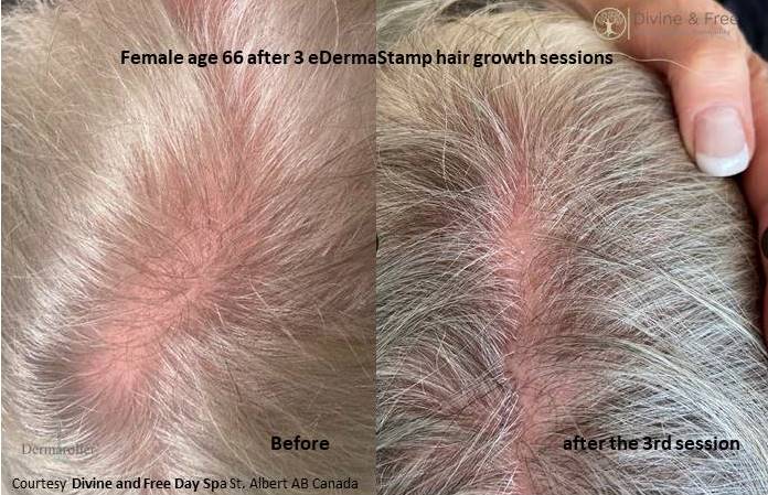 hair growth Dermaroller ba Divine Free a (002)