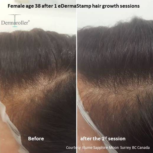 hair growth Dermaroller b&a Illume Sapphire Moon a - Kopie