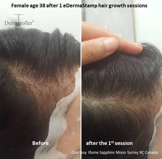 hair growth Dermaroller b&a Illume Sapphire Moon b