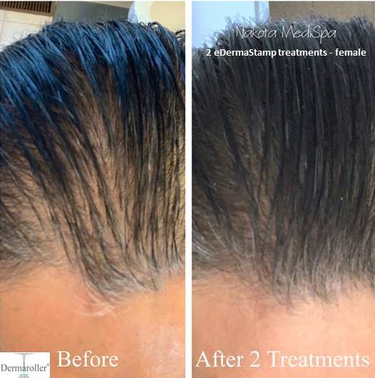 hair growth Dermaroller b&a Nakota MediSpa 2 treatments female - Kopie - Kopie