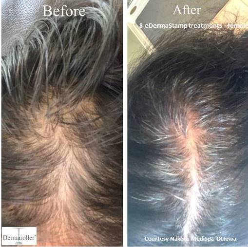 hair growth Dermaroller b&a Nakota MediSpa 8 treatments female