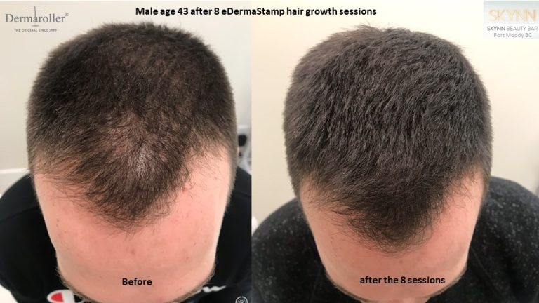 hair growth Dermaroller b&a Skynn Port Moody