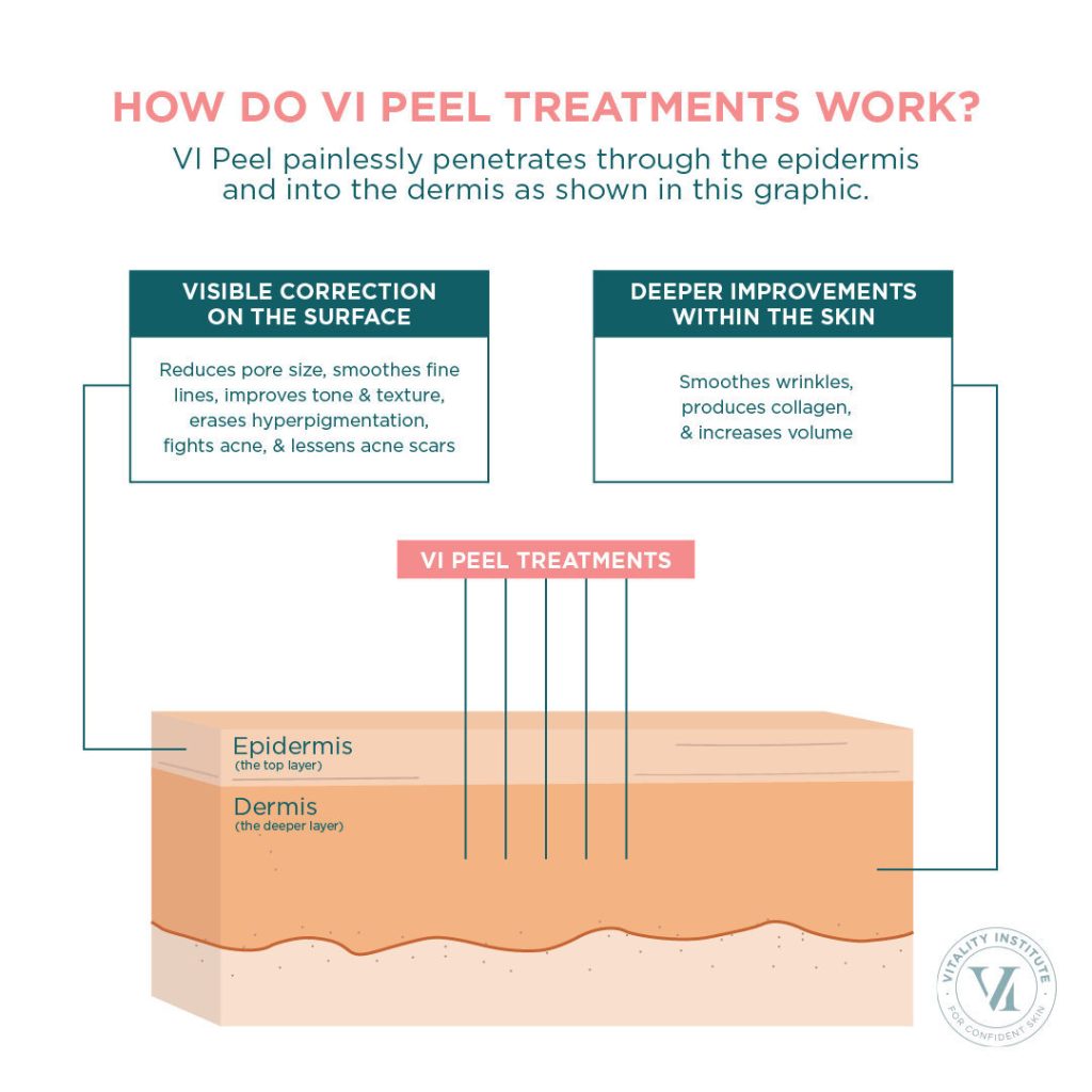 How do Vi Peel treatments work?