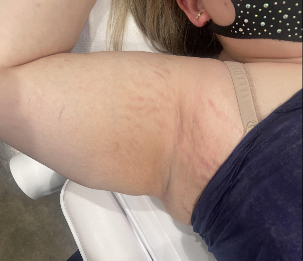 VI Peel Body Stretch Mark AFTER