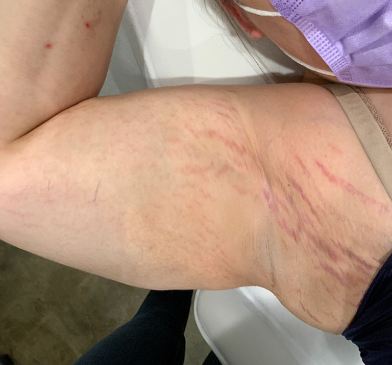 VI-Peel-Body-Stretch-Mark-BEFORE