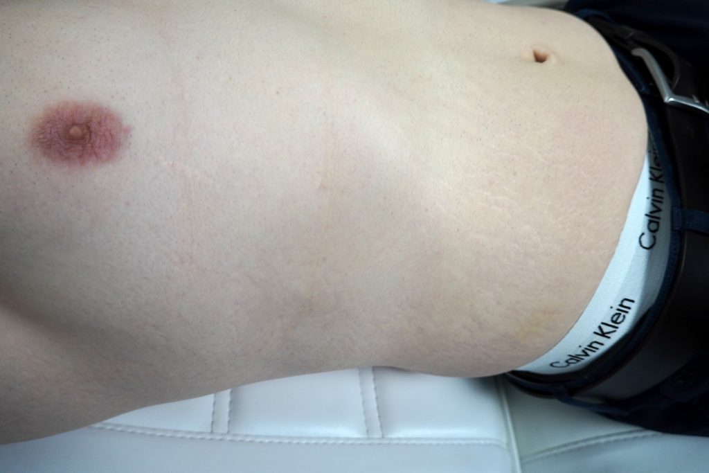 After 1 treatment