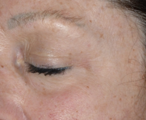 1 After Photoaging Peels 4 Rejuvenating Peels 35, 50 2 x 70