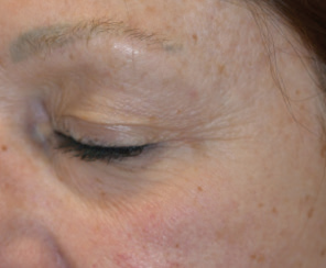 1 Baseline Photoaging Peels 4 Rejuvenating Peels 35, 50 2 x 70