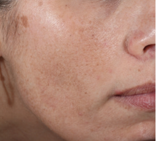 9 Side After Melasma 3 Rejuvenating Peels including 2 peels that were layered with Brightening Peel