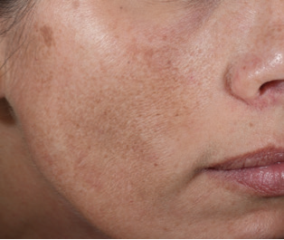 9 Side Baseline Melasma 3 Rejuvenating Peels including 2 peels that were layered with Brightening Peel