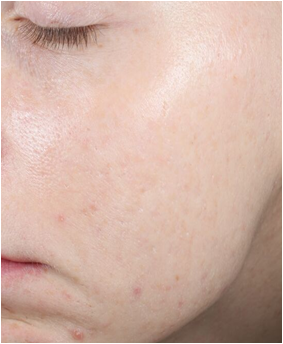 Retinol Peel week 12 after 2 peels